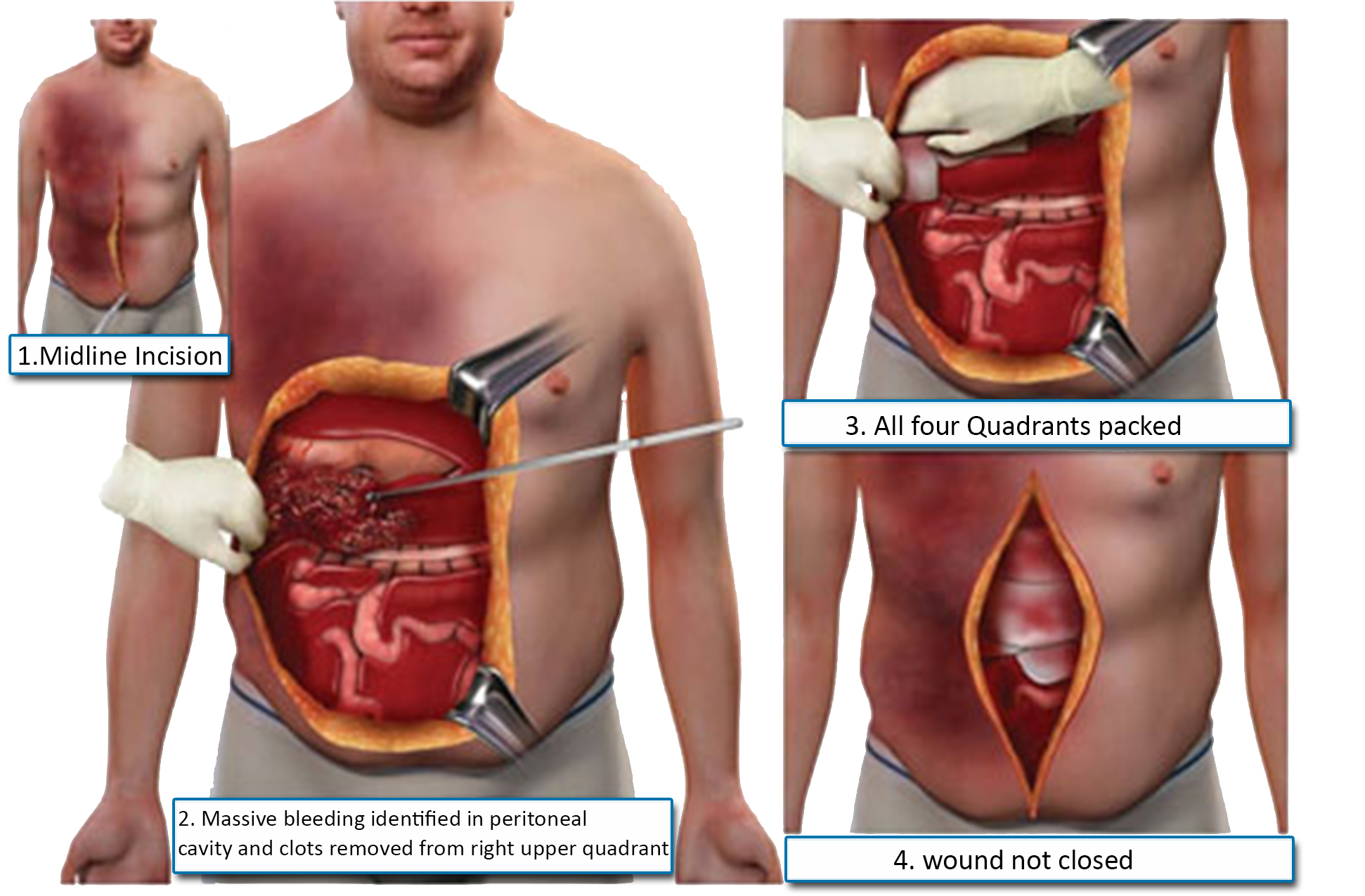 Laparoscopic view. (A) Previously ruptured contents of the right