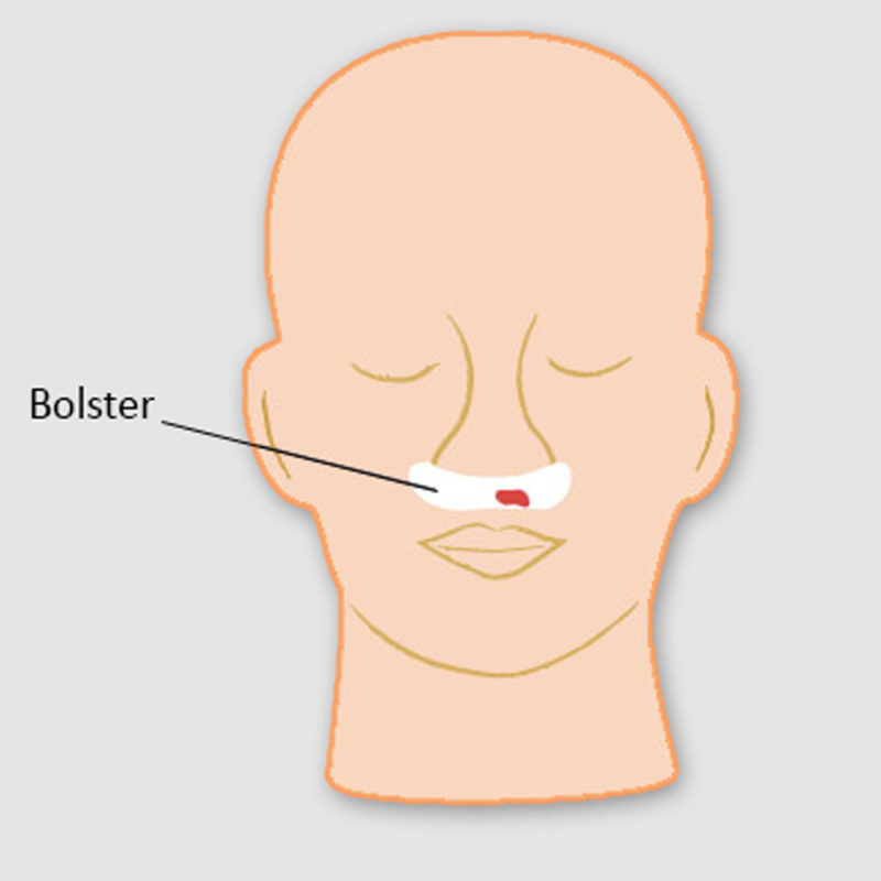 Functional Endoscopic Sinus Surgery (FESS)