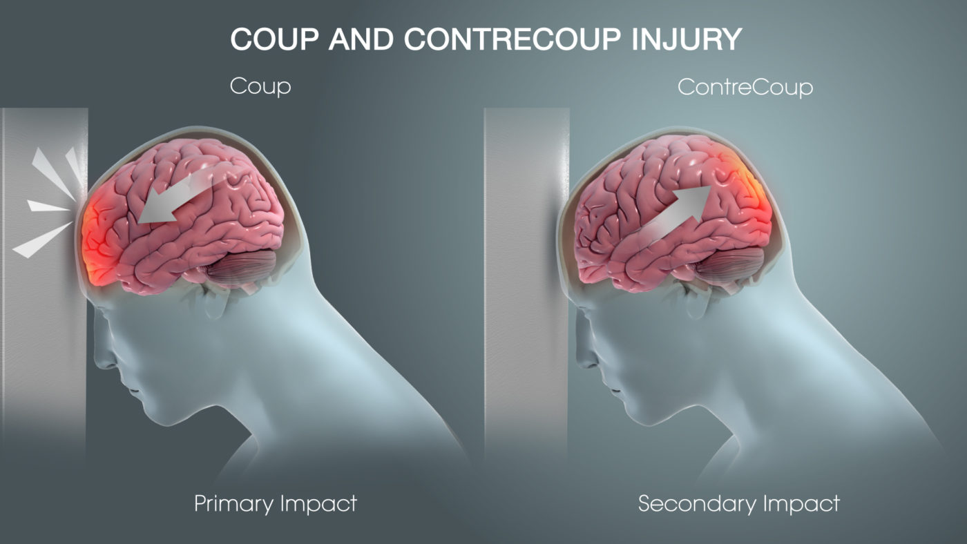 Traumatic Brain Injury (TBI) - Definition, Epidemiology ...