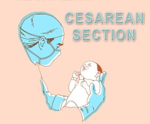 c section